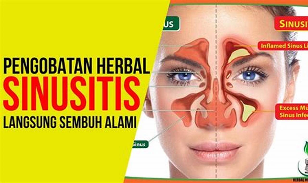 Cara Mengatasi Sinusitis: Panduan Lengkap
